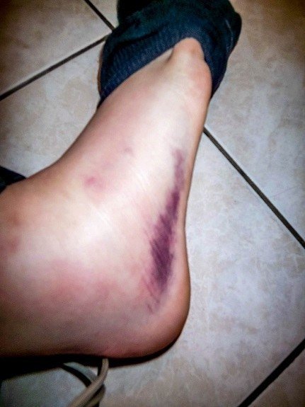 Bruise on Laura after spraining her ankle