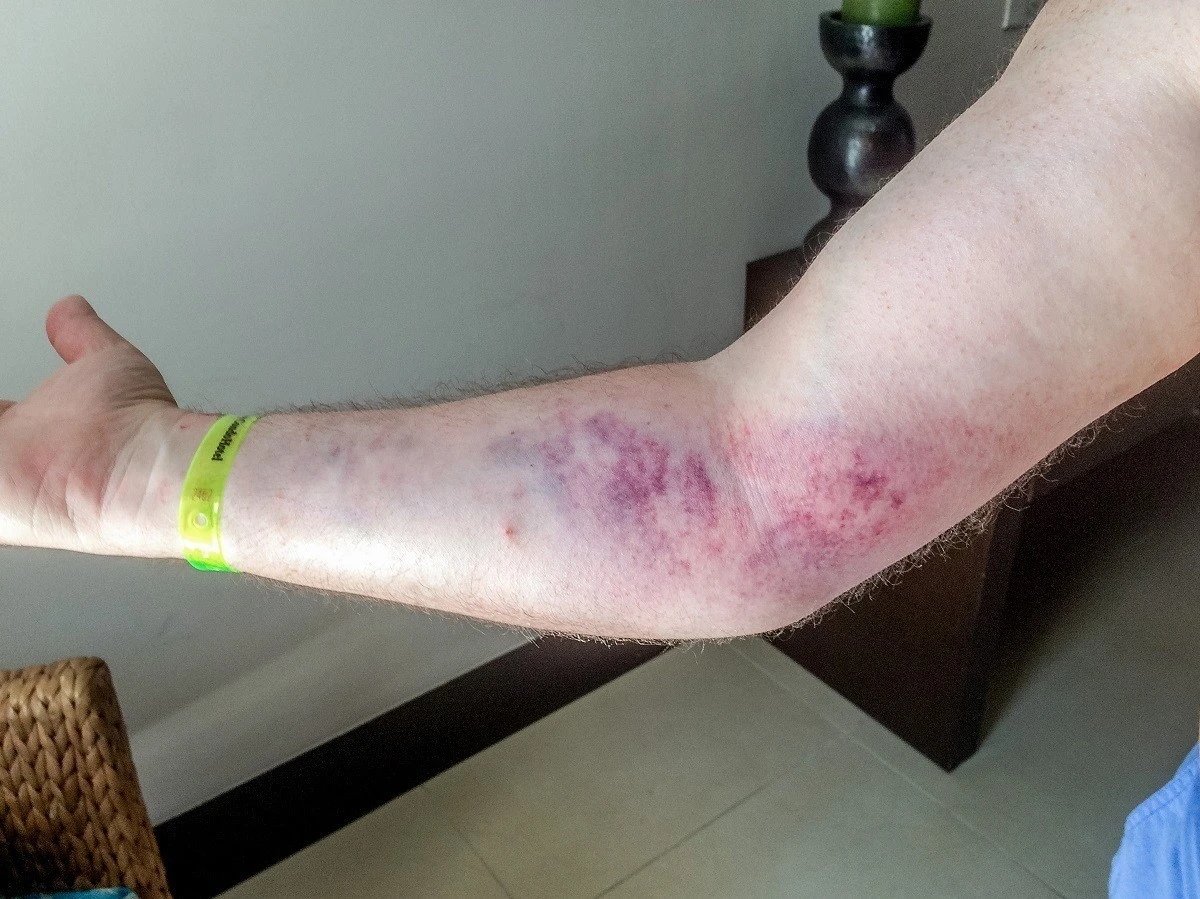 Lance's arm turned purple after bad accident in Mexico